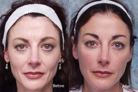 Forehead Lift Case Studies Beverly Hills | Brow Lift Case Los Angeles