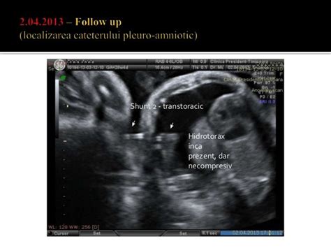 Hidrotorax fetal shunt pleuro amniotic