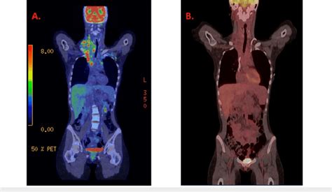 (A) Positron emission tomography scan at the time of presentation. (B ...