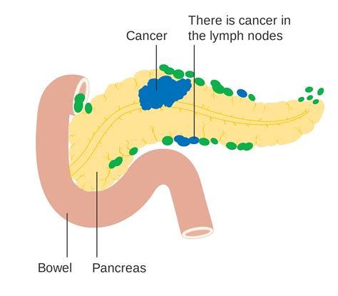 A Diabetes Diagnosis May be First Symptom of Pancreatic Cancer ...