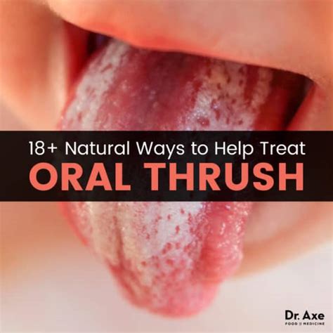 Oral Thrush & 18+ Natural Treatments to Relieve It - Dr. Axe