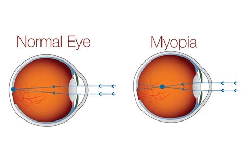 Laser Eye Surgery for Myopia | Short-Sightedness | NewVision Clinics