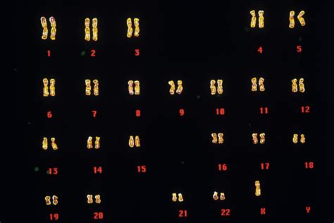 Turner's Syndrome Karyotype Photograph by Gjlp/science Photo Library