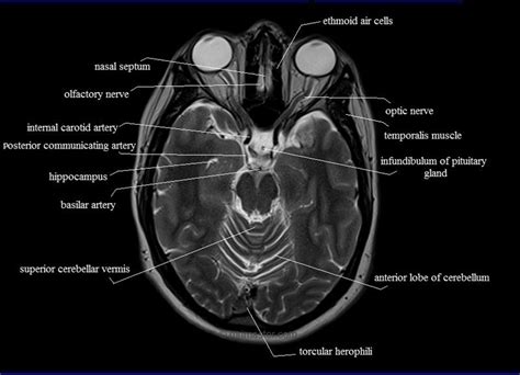 Pituitary Mri Brain Anatomy