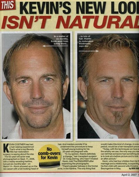 Kevin Costner – hair transplant?