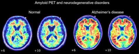 The Role of Amyloid PET in Imaging Neurodegenerative Disorders: A ...