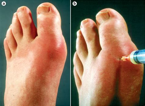 Gout: What it Is, How it’s Treated, and How to Prevent It – Medchrome