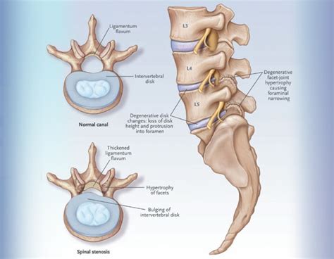 Ligamentum Flavum Hypertrophy Care Options