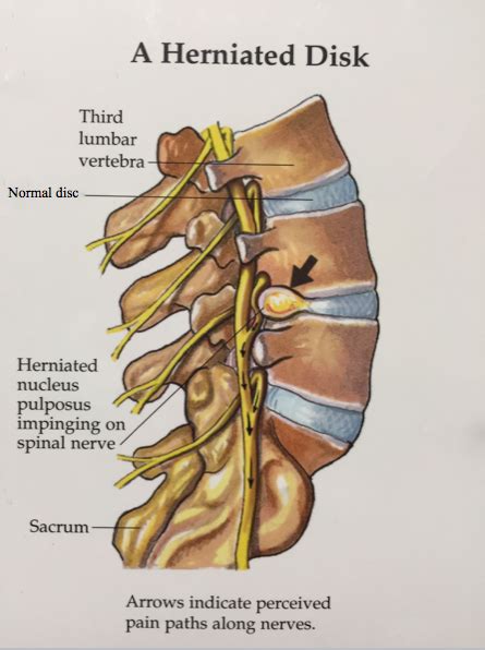 Back Exercises for a Herniated Disc | Cawley Physical Therapy