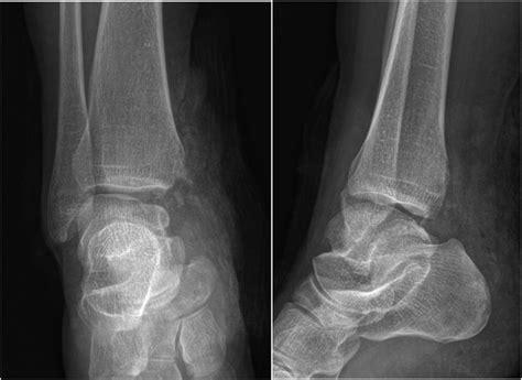 Pre-operation X ray with loss of medial malleolus. | Download ...