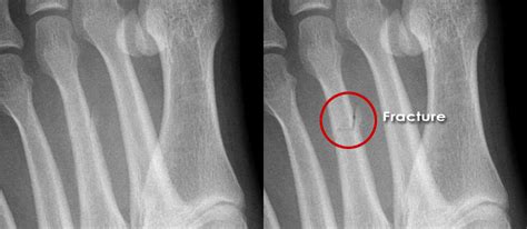 Metatarsal Stress Fracture