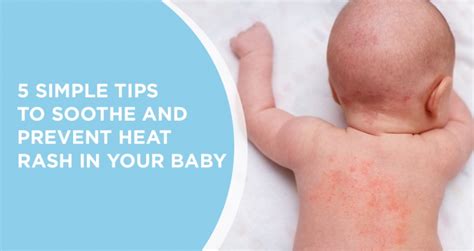 Mild Heat Rash On Babies