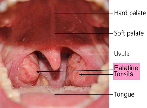 Tonsil stones causes, symptoms, diagnosis and tonsil stones treatment