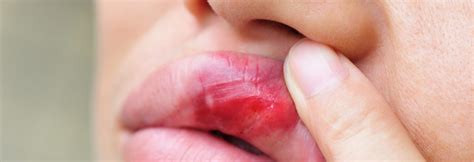 #EULAR 2016: Mouth Ulcers in Lupus May Be Caused by Altered Genetic ...