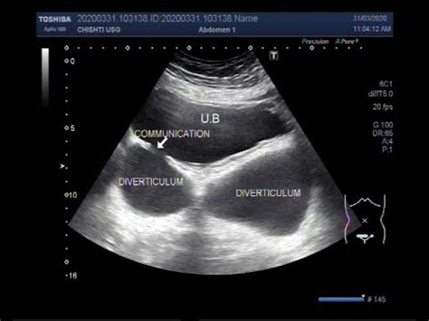 Ultrasound Video showing multiple Diverticula of urinary bladder. - YouTube