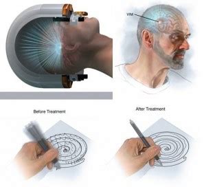 Focused Ultrasound to Treat Essential Tremor - SeattleNeurosciences.com