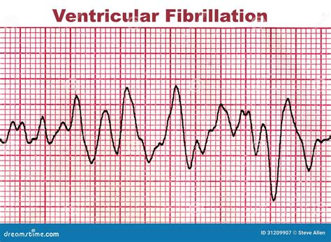 Ventricular Fibrillation