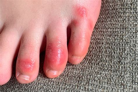 'COVID toes,' other rashes latest possible rare virus signs - WHYY