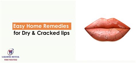 Home Remedies to Treat Dry, Cracked & Chapped Lips