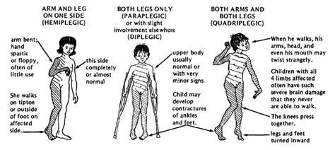 Spastic Cerebral Palsy. Causes, symptoms, treatment Spastic Cerebral Palsy