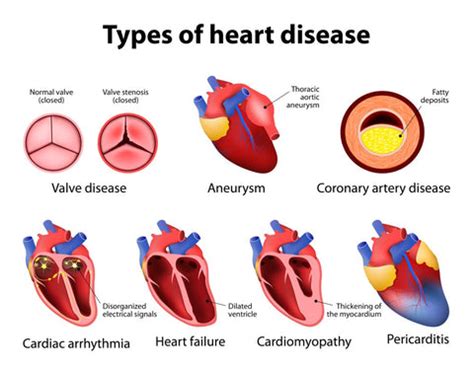 American Heart Month 2023: Preventing Heart Disease with a Heart ...