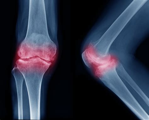 Subchondral Sclerosis: Symptoms, Diagnosis, Treatment