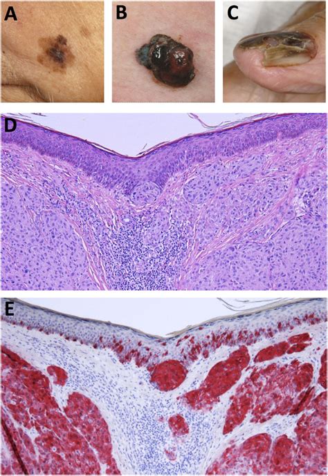 | Clinical and histological presentation of melanoma. (A) Superficial ...