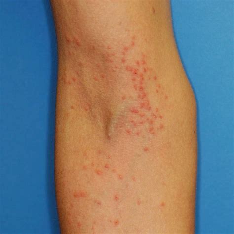 Rash on inner elbow.. please help ID it for me. : Dermatology