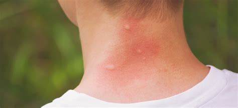 Top 5 Home Remedies for Mosquito Bites - Dr. Axe