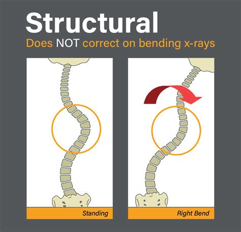 Non-Structural And Structural Scoliosis: What’s The Difference?