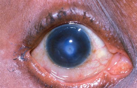 Corneal Ulcer - Pictures, Symptoms, Causes, Treatment - (2018 - Updated)