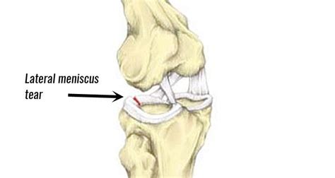 Meniscus Tear Exercises After Surgery – Online degrees