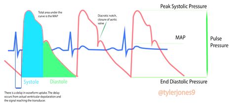 Arterial Line Insertion and Waveforms – CriticalCareNow