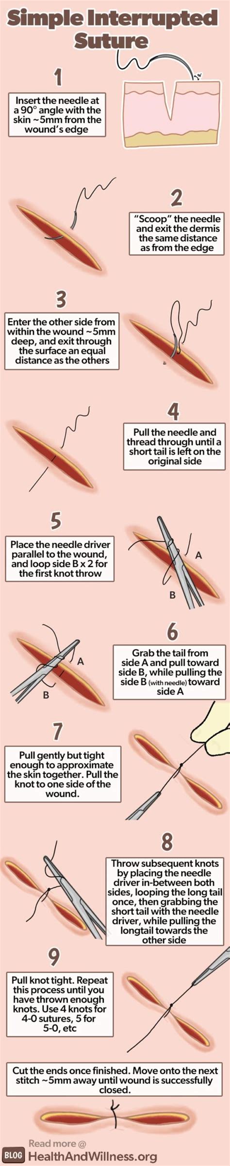 How to Suture: Simple Laceration Repair | Health And Willness