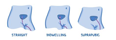 Urinary catheters and routine indwelling catheter care: Clinical skills ...