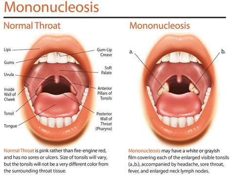 Mononucleosis infecciosa | Odontoblog