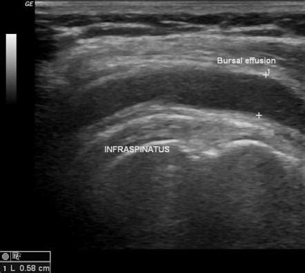 Subdeltoid Bursitis Ultrasound