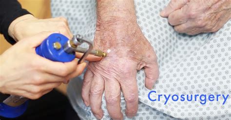 Cryosurgery for skin warts and tags – TALA