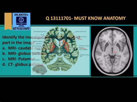 Basal Ganglia Anatomy Mri