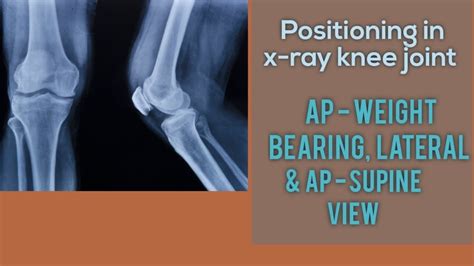 x ray knee joint ap lateral view | x ray knee standing | x ray knee ...