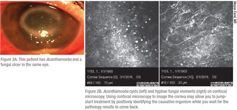 Corneal Ulcers: Workup & Treatment