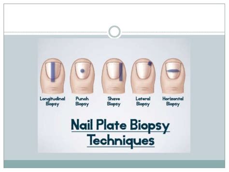 Nail biopsy