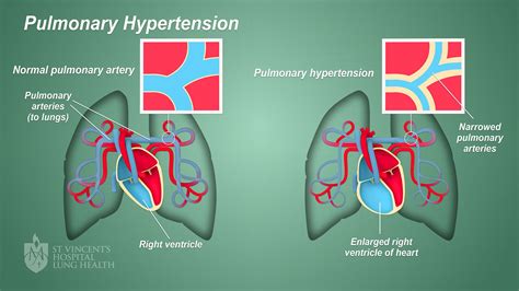 Pulmonary Embolism ECG Changes