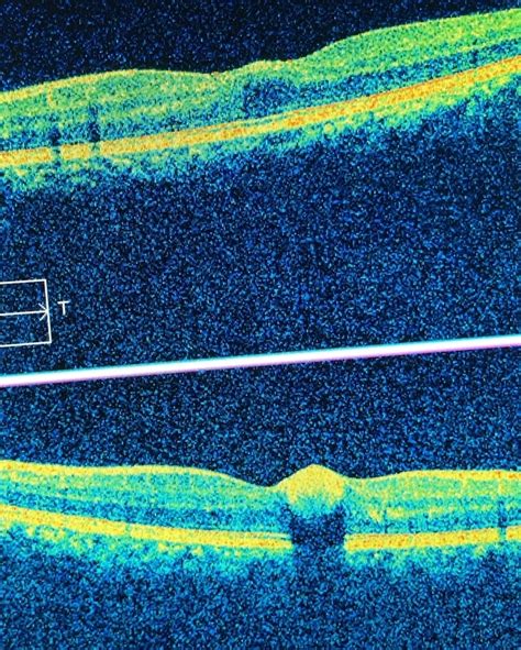 Valsalva Retinopathy - Retina Image Bank