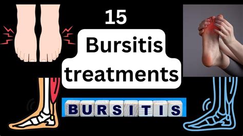 15 Bursitis treatments - heel bursitis & achilles tendon bursitis [best ...