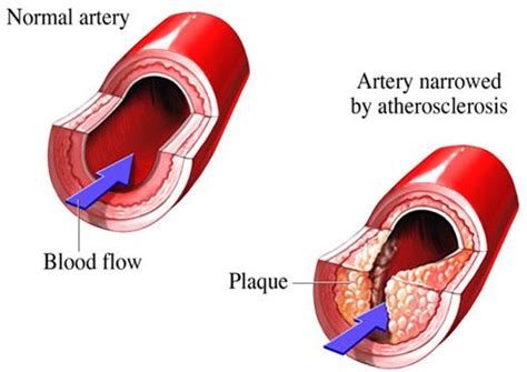 Treating atherosclerosis