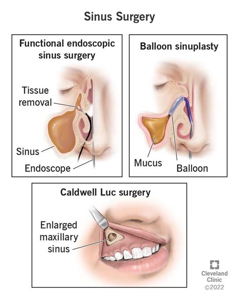 What Is A Nasal Endoscopy Procedure? (Indications, Side Effect Uses ...