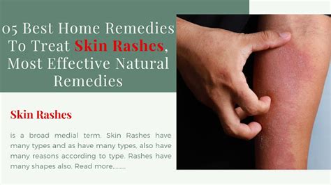 05 Best Home Remedies To Treat Skin Rashes, Most Effective Natural ...