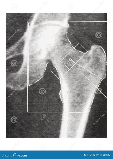 Bone Density Medical Scan - Hip. Osteoporosis Diagnosis. Stock Photo ...