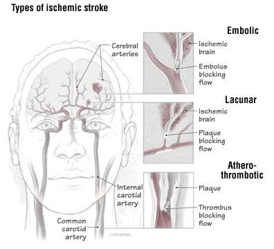 Infarction: Pontine Infarction Symptoms